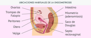 Ubicaciones habituales de la endometriosis