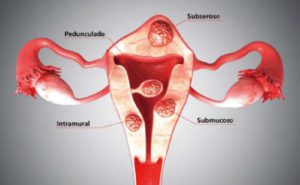 Tipos de miomas uterinos